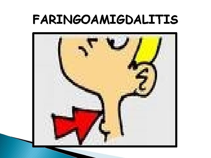 FARINGOAMIGDALITIS 