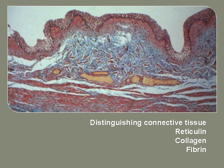 Distinguishing connective tissue Reticulin Collagen Fibrin 