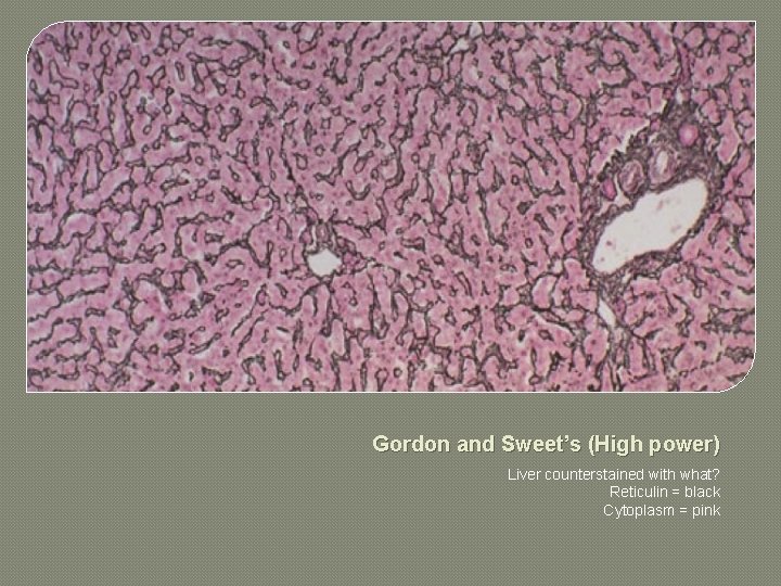 Gordon and Sweet’s (High power) Liver counterstained with what? Reticulin = black Cytoplasm =