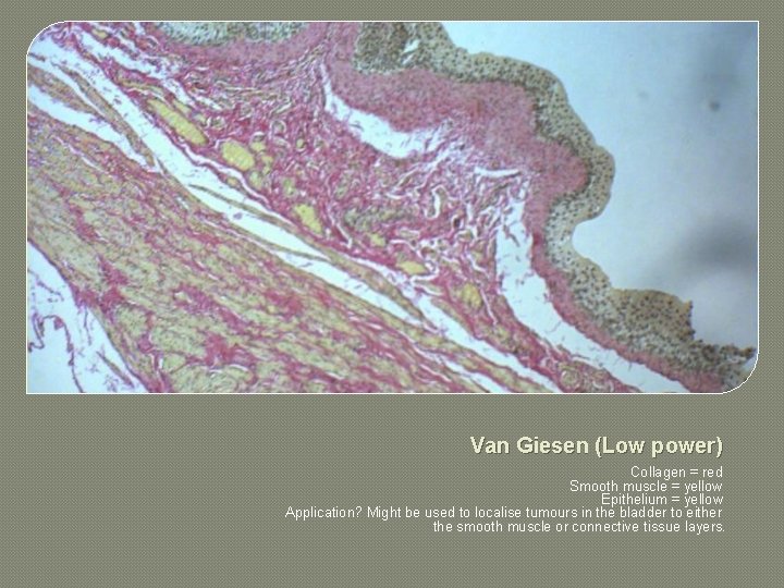 Van Giesen (Low power) Collagen = red Smooth muscle = yellow Epithelium = yellow