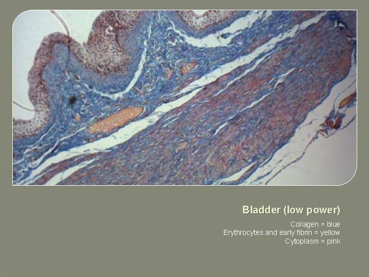 Bladder (low power) Collagen = blue Erythrocytes and early fibrin = yellow Cytoplasm =