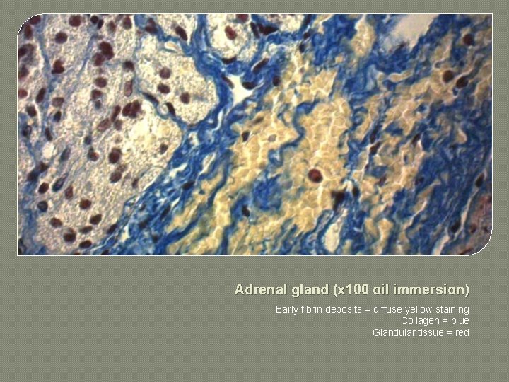 Adrenal gland (x 100 oil immersion) Early fibrin deposits = diffuse yellow staining Collagen