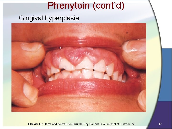 Phenytoin (cont’d) Gingival hyperplasia Elsevier Inc. items and derived items © 2007 by Saunders,