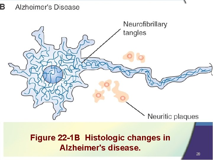 Figure 22 -1 B Histologic changes in Alzheimer's disease. 28 