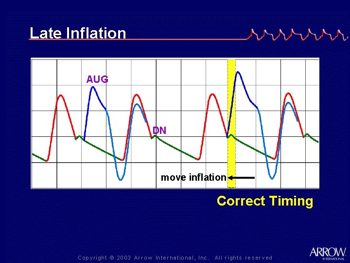 Late Inflation AUG DN move inflation Correct Timing 