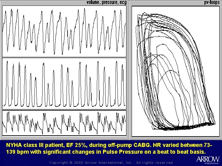 NYHA class III patient, EF 25%, during off-pump CABG. HR varied between 73139 bpm