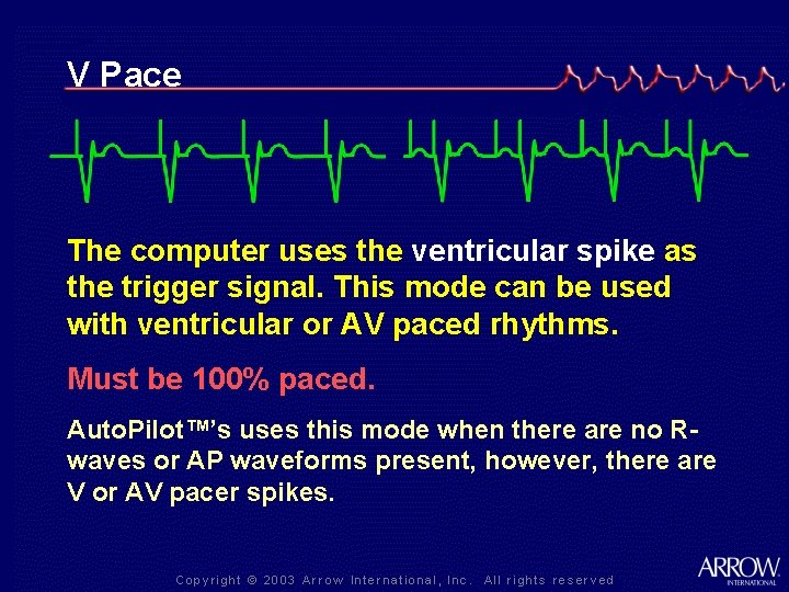 V Pace The computer uses the ventricular spike as the trigger signal. This mode
