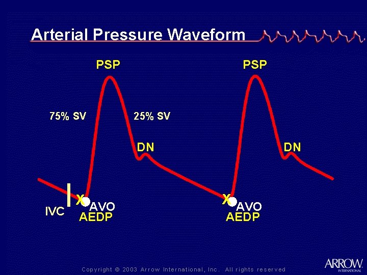Arterial Pressure Waveform PSP 75% SV PSP 25% SV DN IVC X AVO AEDP