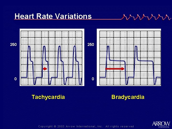 Heart Rate Variations 250 0 0 Tachycardia Bradycardia 