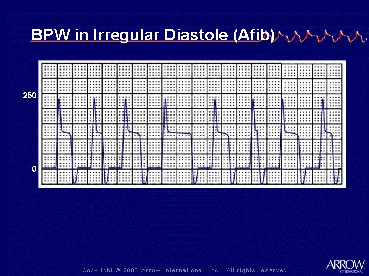 BPW in Irregular Diastole (Afib) 250 0 