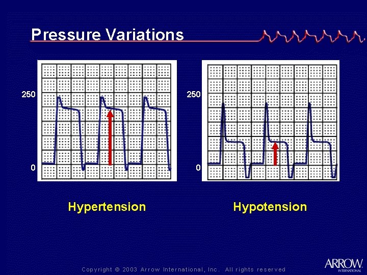 Pressure Variations 250 0 0 Hypertension Hypotension 