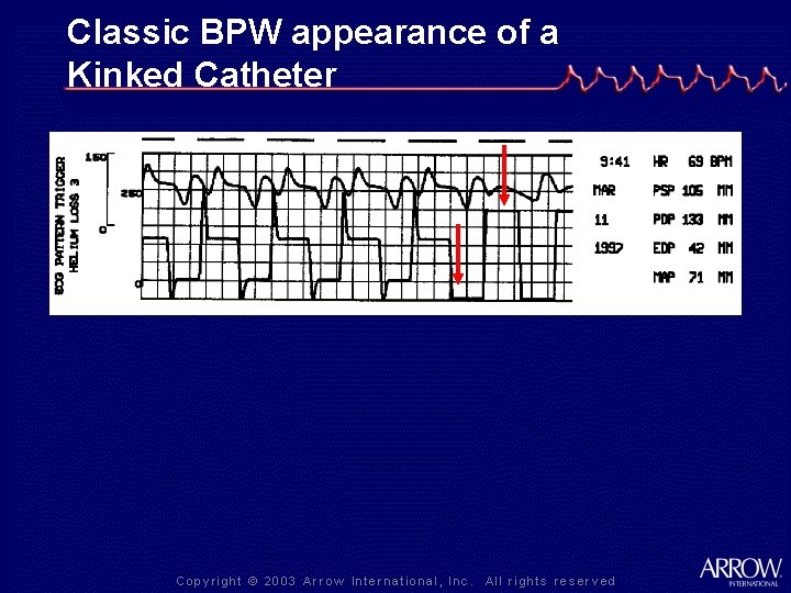 Classic BPW appearance of a Kinked Catheter 