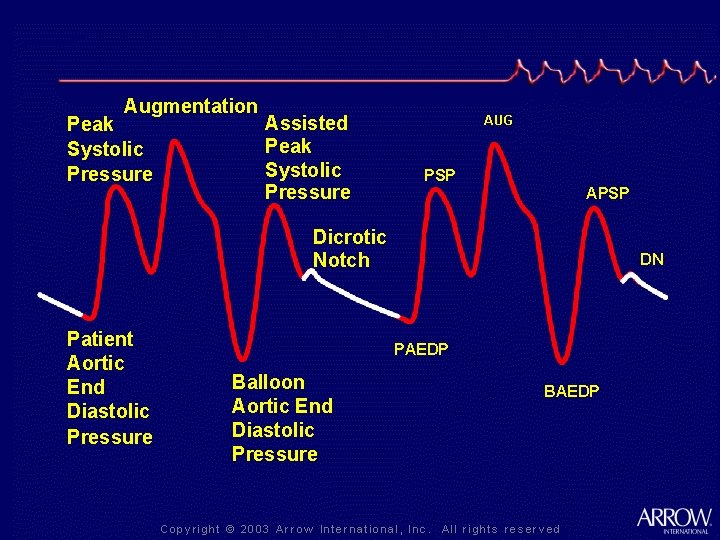 Augmentation Peak Systolic Pressure Assisted Peak Systolic Pressure AUG PSP APSP Dicrotic Notch Patient