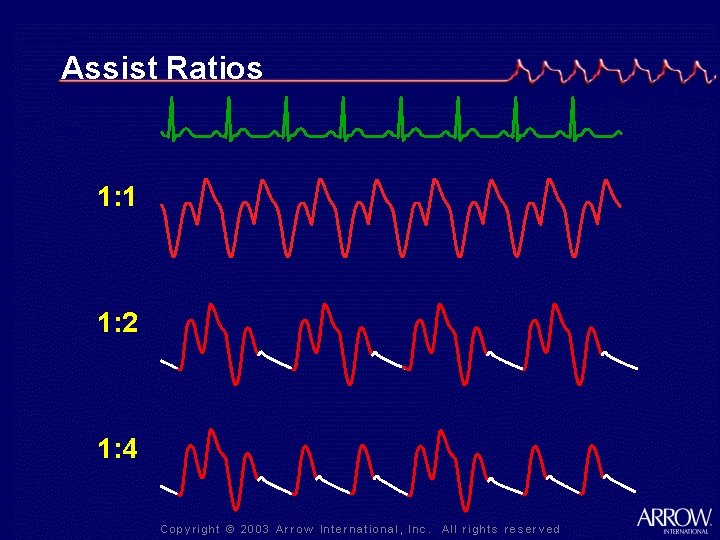 Assist Ratios 1: 1 1: 2 1: 4 