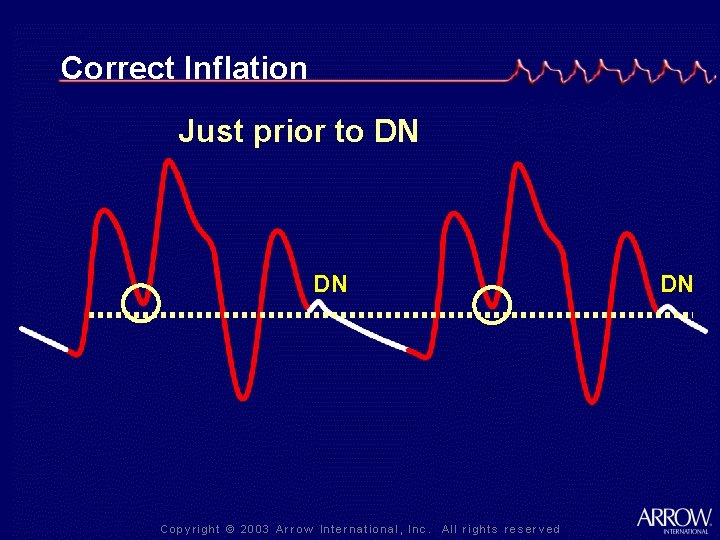 Correct Inflation Just prior to DN DN DN 