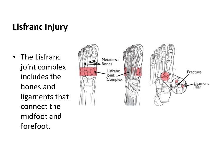 Lisfranc Injury • The Lisfranc joint complex includes the bones and ligaments that connect