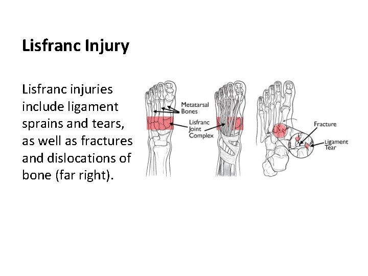 Lisfranc Injury Lisfranc injuries include ligament sprains and tears, as well as fractures and