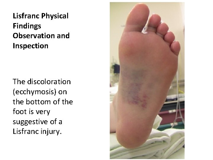 Lisfranc Physical Findings Observation and Inspection The discoloration (ecchymosis) on the bottom of the