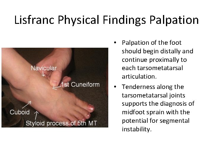 Lisfranc Physical Findings Palpation • Palpation of the foot should begin distally and continue