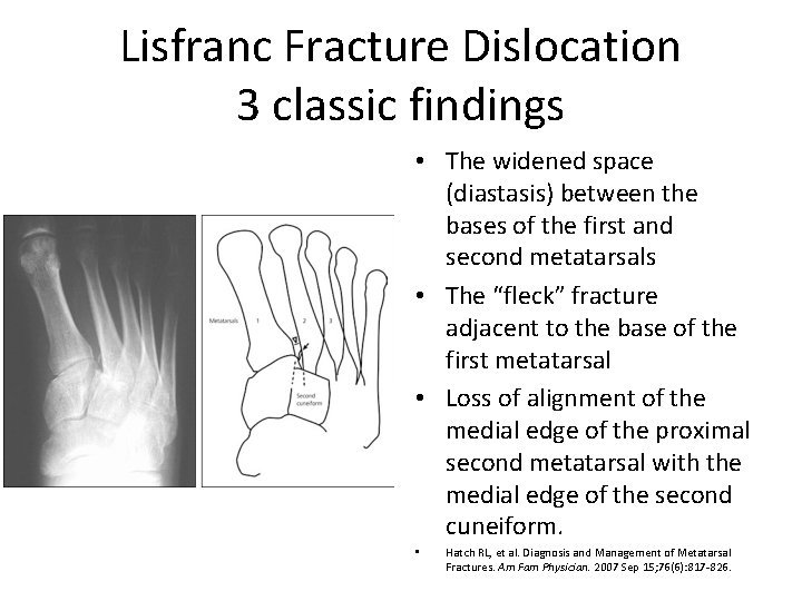 Lisfranc Fracture Dislocation 3 classic findings • The widened space (diastasis) between the bases