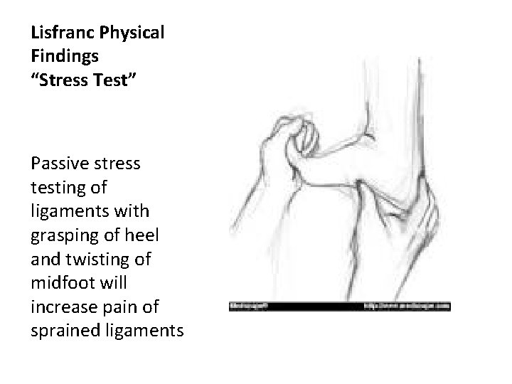 Lisfranc Physical Findings “Stress Test” Passive stress testing of ligaments with grasping of heel