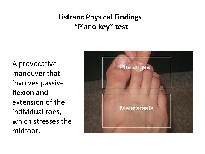 Lisfranc Physical Findings “Piano key” test A provocative maneuver that involves passive flexion and