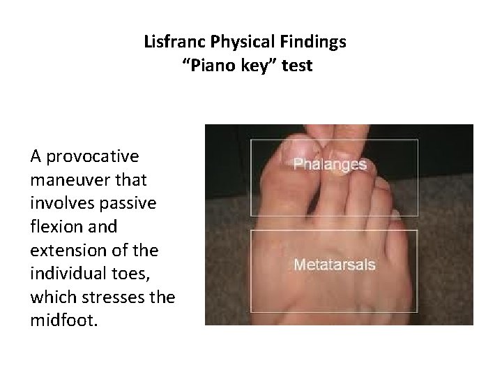 Lisfranc Physical Findings “Piano key” test A provocative maneuver that involves passive flexion and