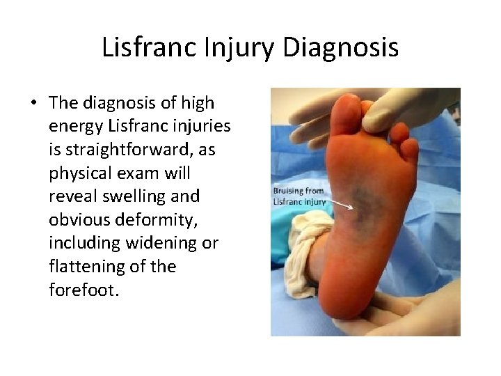 Lisfranc Injury Diagnosis • The diagnosis of high energy Lisfranc injuries is straightforward, as