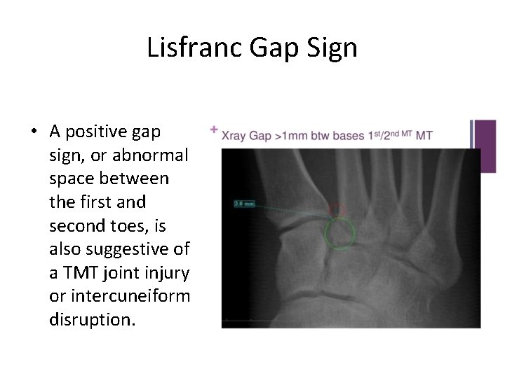 Lisfranc Gap Sign • A positive gap sign, or abnormal space between the first