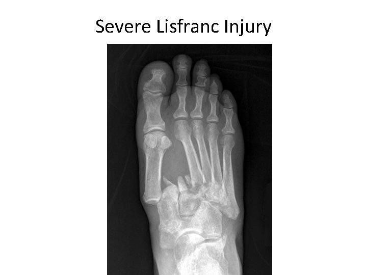 Severe Lisfranc Injury 