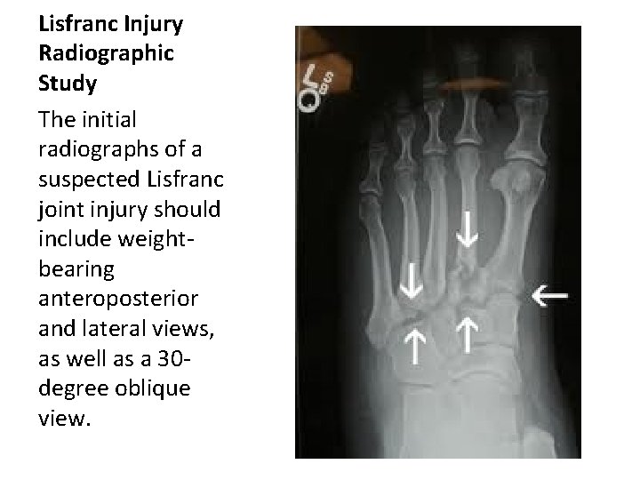 Lisfranc Injury Radiographic Study The initial radiographs of a suspected Lisfranc joint injury should