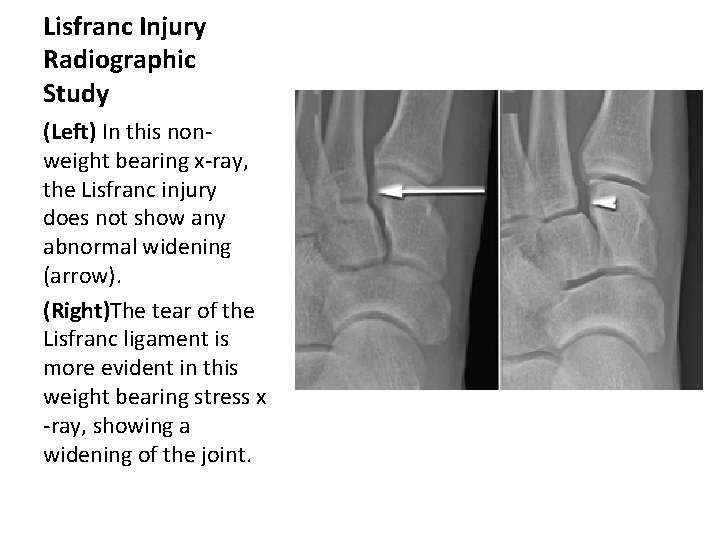 Lisfranc Injury Radiographic Study (Left) In this nonweight bearing x-ray, the Lisfranc injury does
