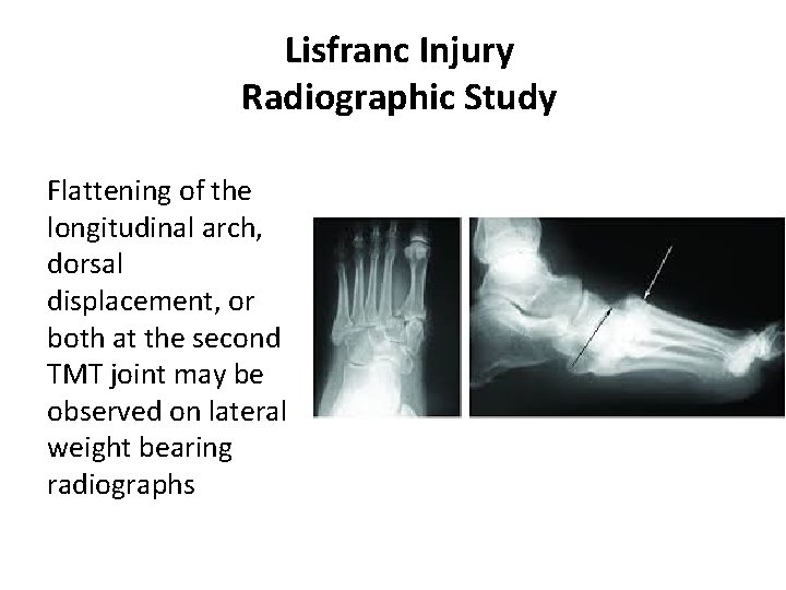 Lisfranc Injury Radiographic Study Flattening of the longitudinal arch, dorsal displacement, or both at