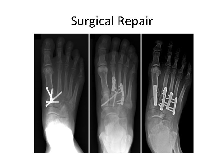 Surgical Repair 