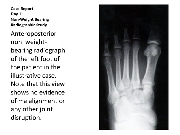 Case Report Day 1 Non-Weight Bearing Radiographic Study Anteroposterior non–weightbearing radiograph of the left