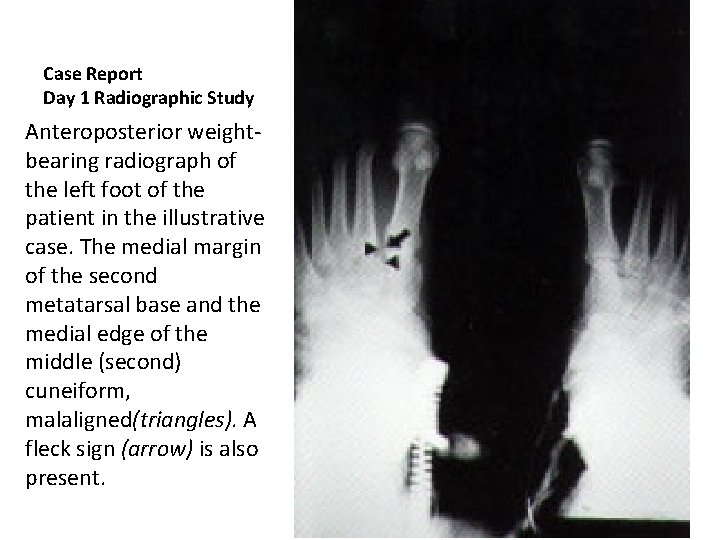 Case Report Day 1 Radiographic Study Anteroposterior weightbearing radiograph of the left foot of