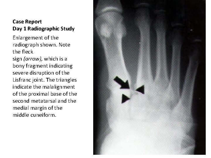 Case Report Day 1 Radiographic Study Enlargement of the radiograph shown. Note the fleck