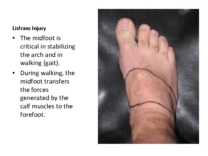 Lisfranc Injury • The midfoot is critical in stabilizing the arch and in walking