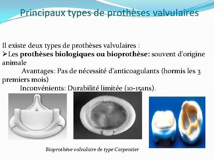 Principaux types de prothèses valvulaires Il existe deux types de prothèses valvulaires : ØLes