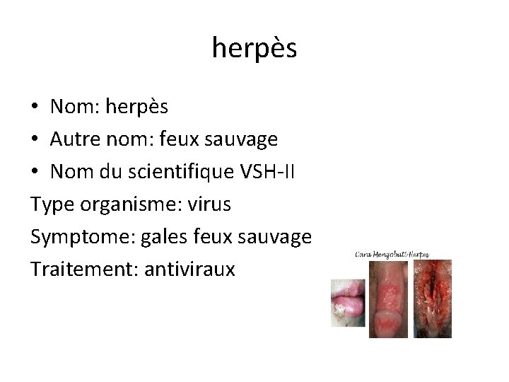 herpès • Nom: herpès • Autre nom: feux sauvage • Nom du scientifique VSH-II