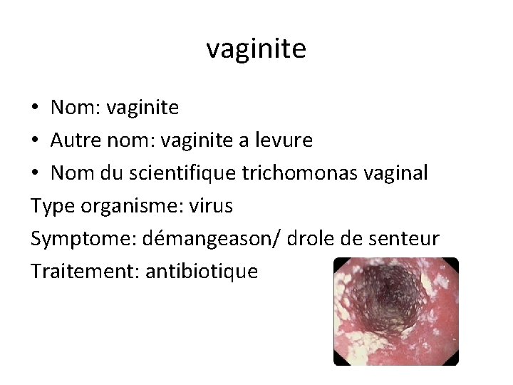 vaginite • Nom: vaginite • Autre nom: vaginite a levure • Nom du scientifique