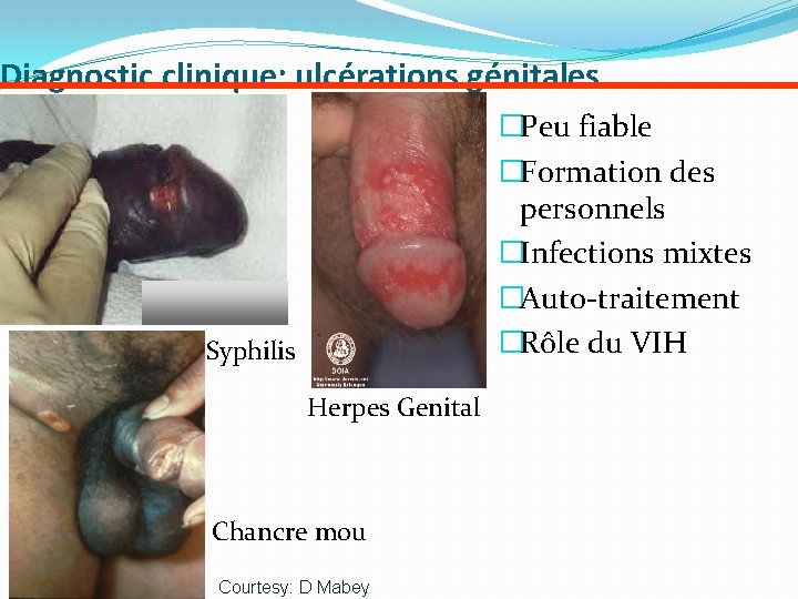 Infections Sexuellement Transmissibles Ist Et Prvention Du Vih