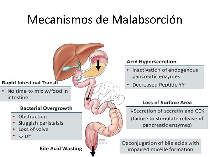 Mecanismos de Malabsorción Mecanismos de Malabsorción
