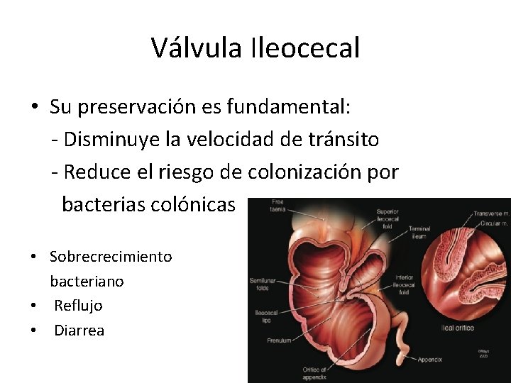 Válvula Ileocecal • Su preservación es fundamental: - Disminuye la velocidad de tránsito - Válvula Ileocecal • Su preservación es fundamental: - Disminuye la velocidad de tránsito -