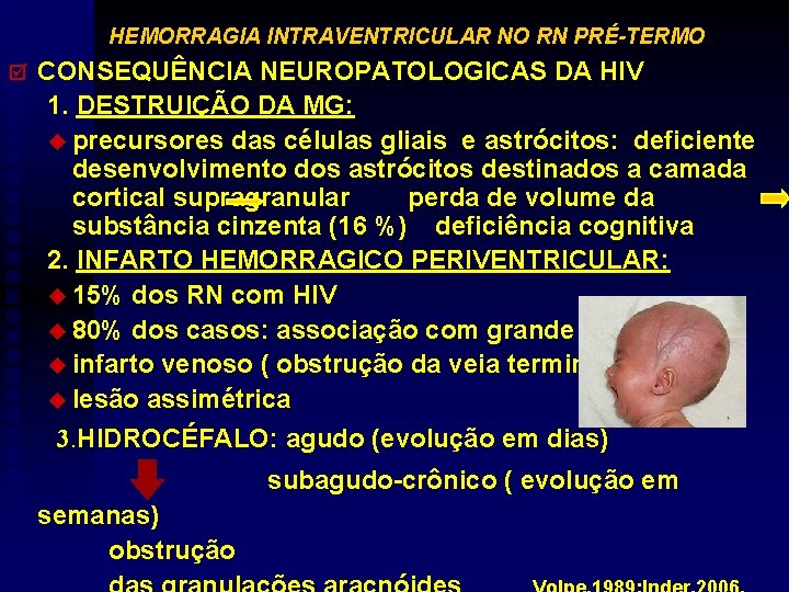 HEMORRAGIA INTRAVENTRICULAR NO RN PRÉ-TERMO þ CONSEQUÊNCIA NEUROPATOLOGICAS DA HIV 1. DESTRUIÇÃO DA MG: