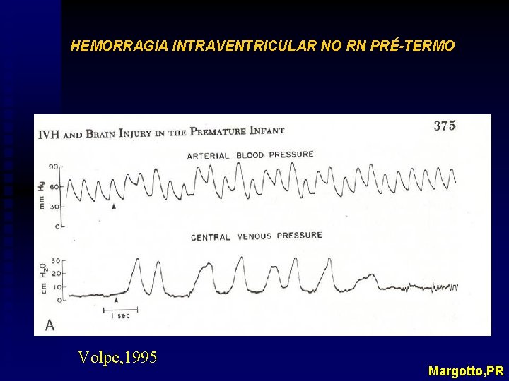 HEMORRAGIA INTRAVENTRICULAR NO RN PRÉ-TERMO Volpe, 1995 Margotto, PR 