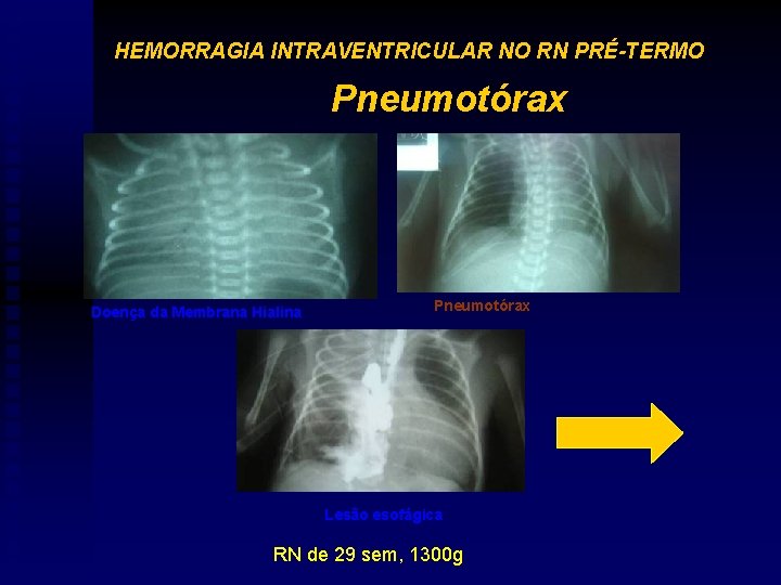 HEMORRAGIA INTRAVENTRICULAR NO RN PRÉ-TERMO Pneumotórax Doença da Membrana Hialina Pneumotórax Lesão esofágica RN