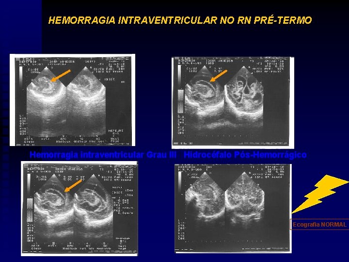 HEMORRAGIA INTRAVENTRICULAR NO RN PRÉ-TERMO Hemorragia intraventricular Grau III Hidrocéfalo Pós-Hemorrágico Ecografia NORMAL 