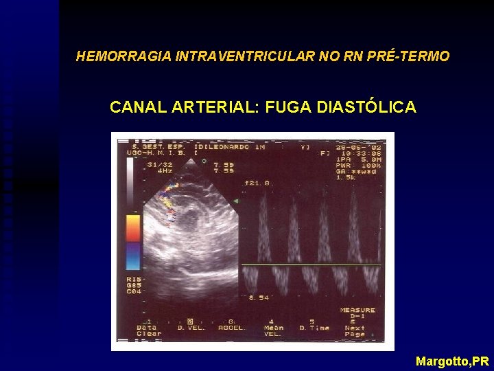 HEMORRAGIA INTRAVENTRICULAR NO RN PRÉ-TERMO CANAL ARTERIAL: FUGA DIASTÓLICA Margotto, PR 