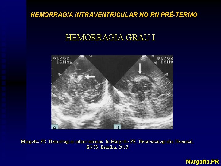 HEMORRAGIA INTRAVENTRICULAR NO RN PRÉ-TERMO HEMORRAGIA GRAU I Margotto PR. Hemorragias intracranianas. In. Margotto